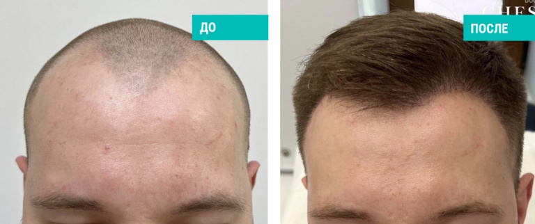 Пересадка волос. Пластический хирург: Чесалин И.П.