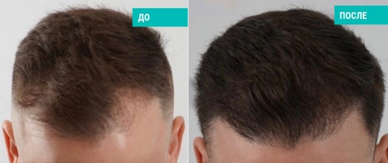 Пересадка волос. Пластический хирург: Сергеев Д.И.