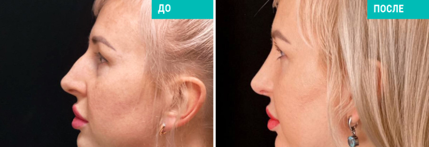 Ринопластика