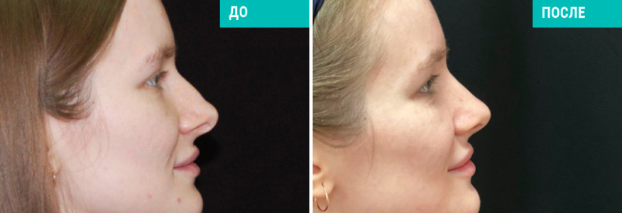 Ринопластика