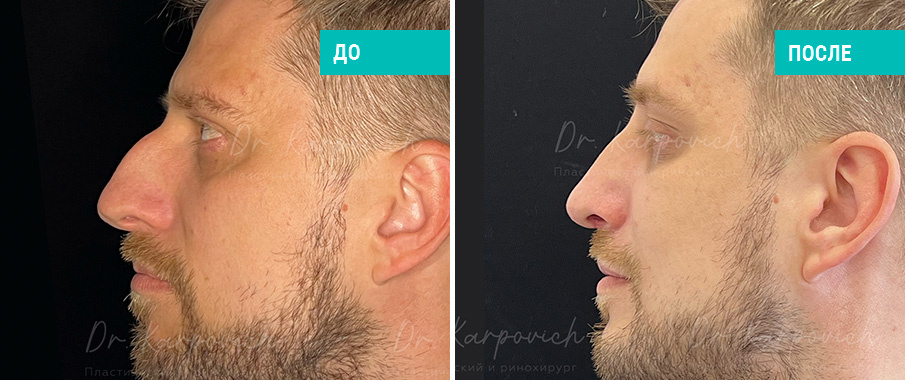 До и после ринопластики. Пластический хирург С. М. Карпович