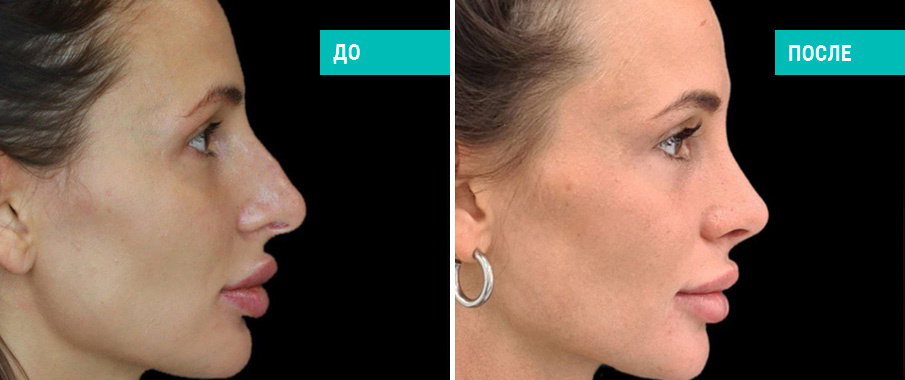 До и после ринопластики. Пластический хирург Д. В. Пахилин