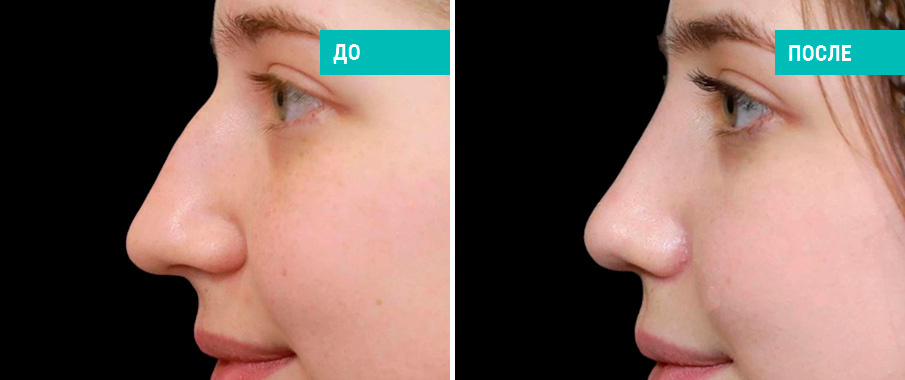 До и после ринопластики. Пластический хирург Д. В. Пахилин