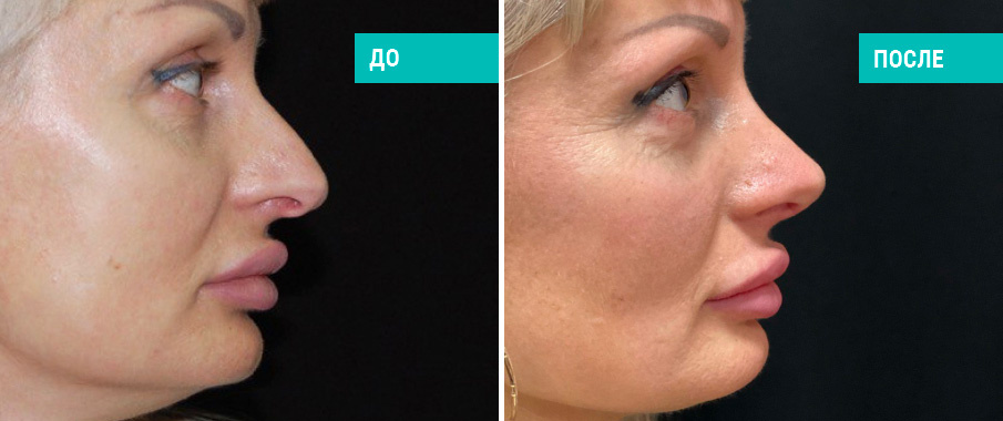 До и после ринопластики. Пластический хирург Д. С. Меркулов