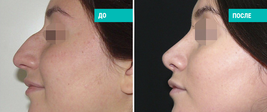 До и после ринопластики. Хирург Г. П. Бабаян