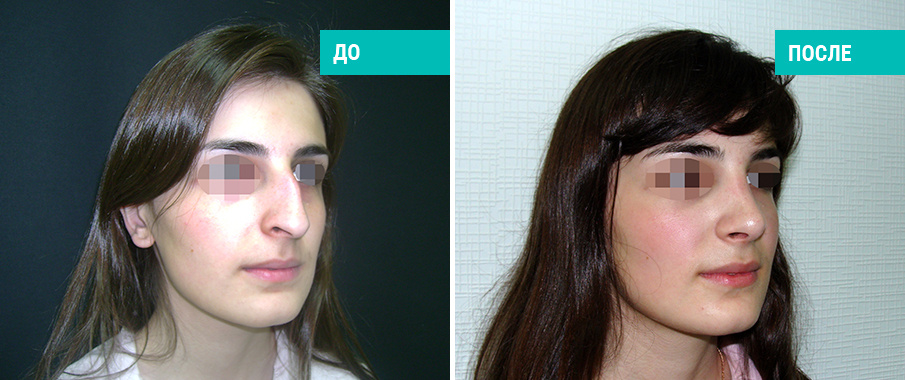 До и после ринопластики. Пластический хирург Г. П. Бабаян