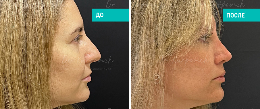 До и после ринопластики. Пластический хирург Карпович С. М.