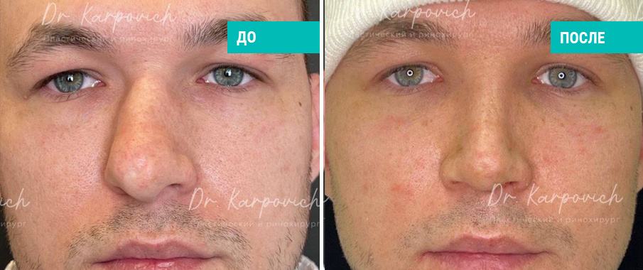 До и после ринопластики. Пластический хирург С. М. Карпович