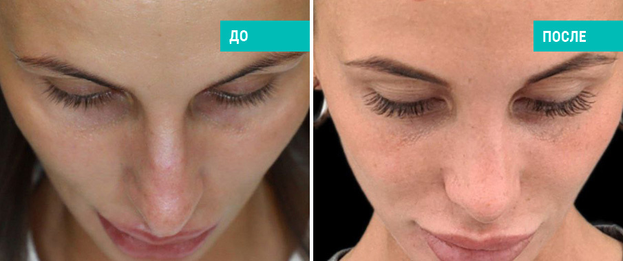 До и после ринопластики. Пластический хирург Пахилин Д. В.