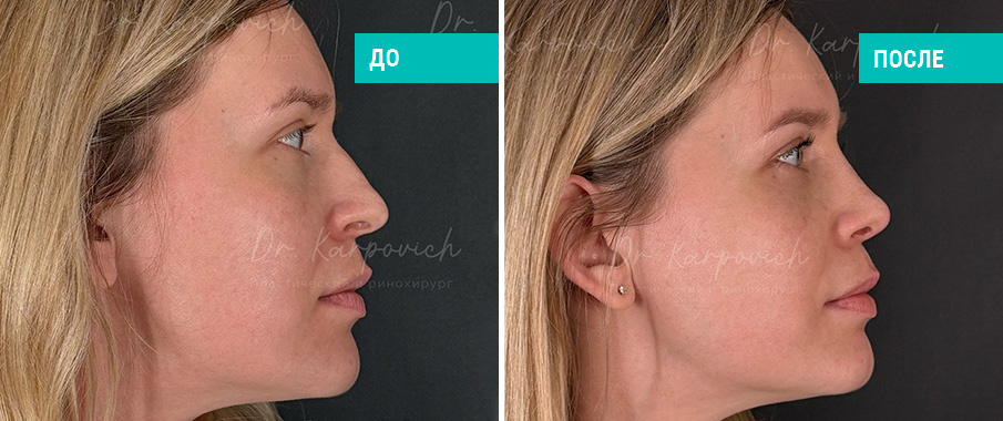До и после ринопластики. Пластический хирург Карпович С. М.