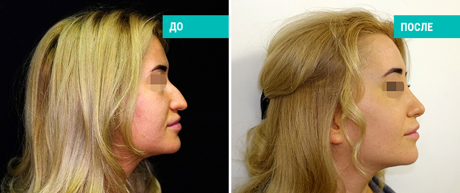 До и после ринопластики. Пластический хирург Бабаян Г. П.