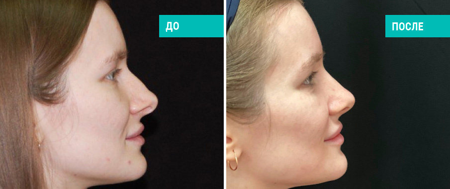 До и после ринопластики. Пластический хирург Меркулов Д. С.