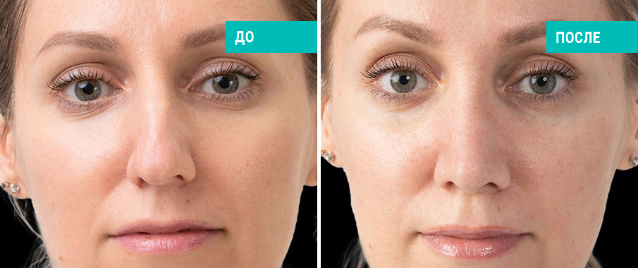 До и после ринопластики. Пластический хирург Д. В. Пахилин