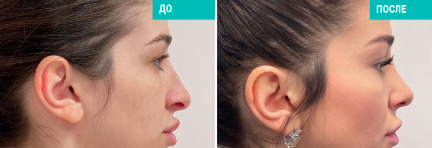 Риносептопластика