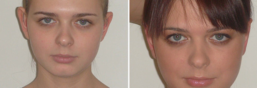 Отопластика