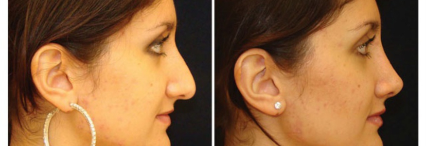 Ринопластика 