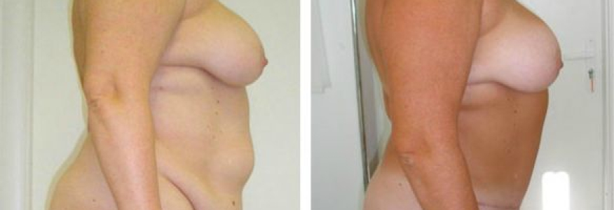 Абдоминопластика