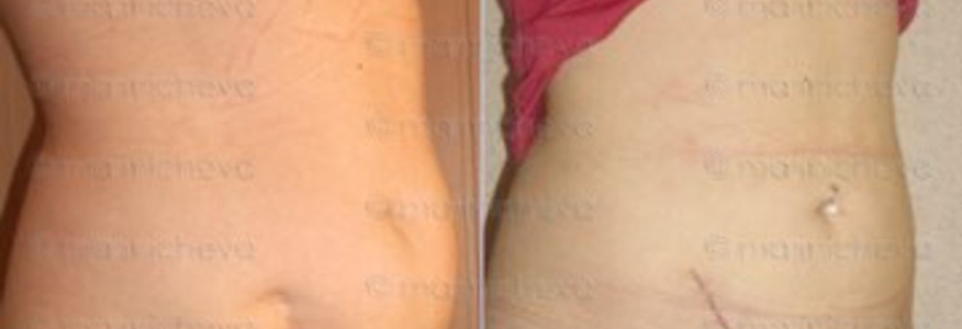 Липосакция