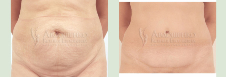 Абдоминопластика