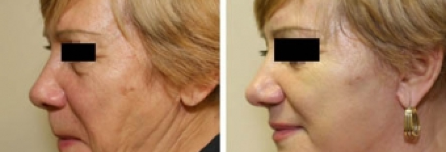 Фейслифтинг