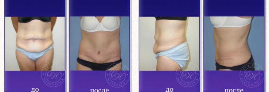 Липосакция