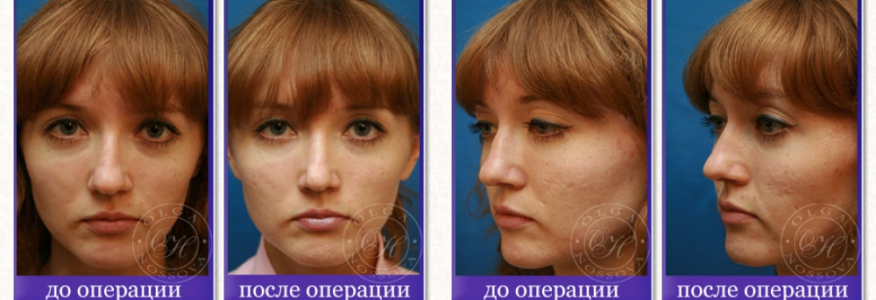 Ринопластика