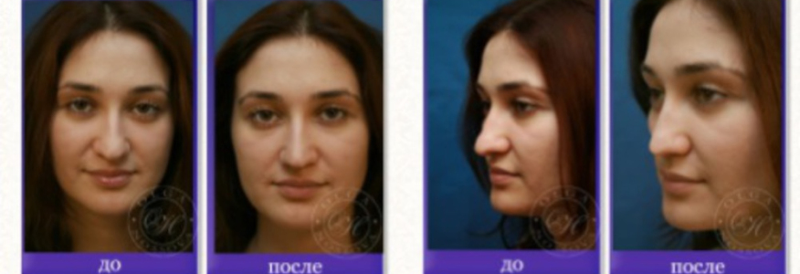 Ринопластика