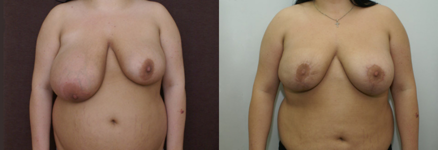 Уменьшение груди