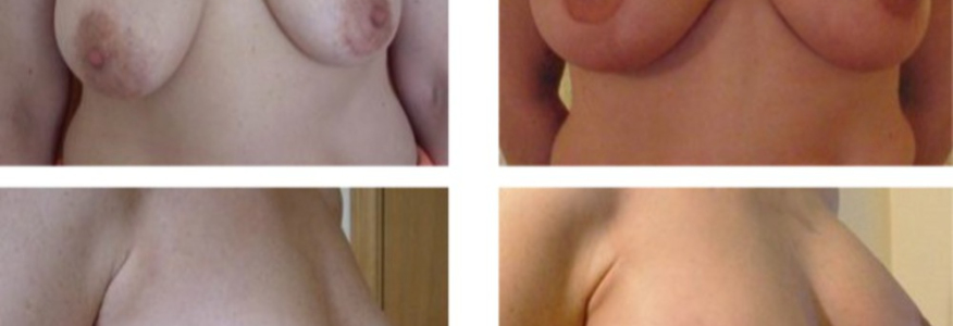 Подтяжка груди