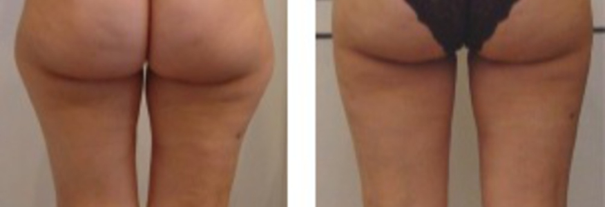 Липосакция